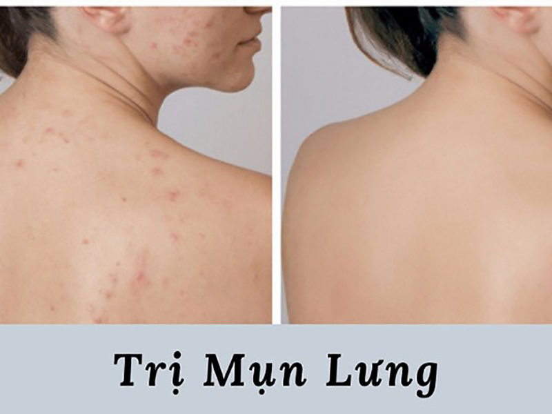 cách trị mụn lưng